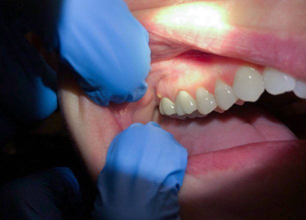 Best Emergency Treatment for Dental Infections or Abscesses in Elkhart, IN